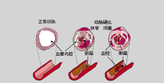 高血压并发症有哪些 揭秘四类高血压症状